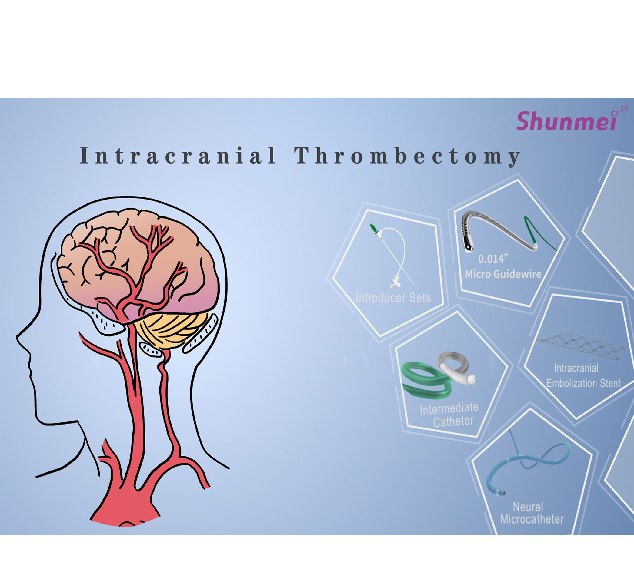 Intracranial Thrombectomy