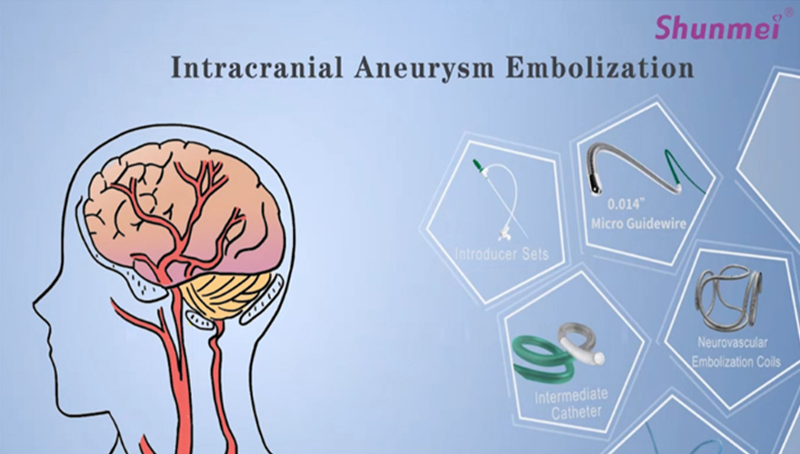 intracranial aneurysm embolization of neurovascular embolization coil