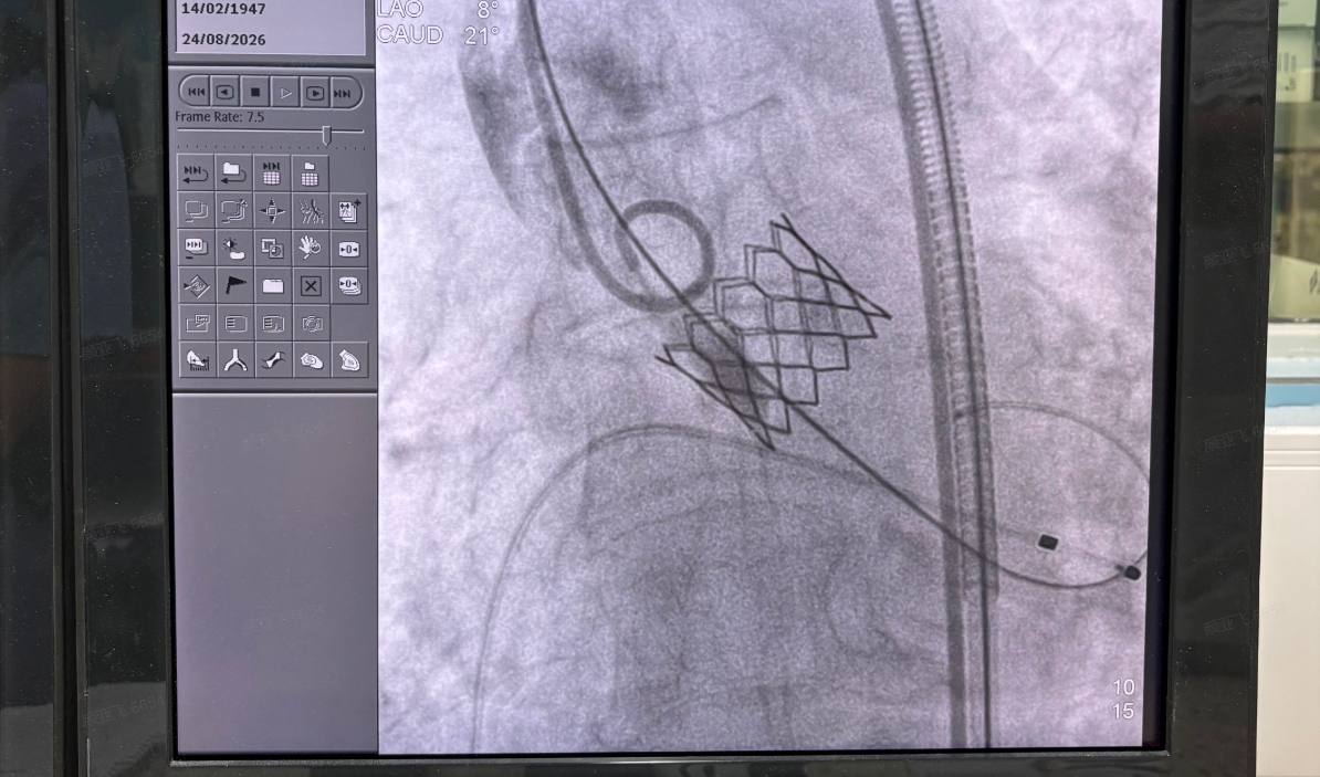 SunValve TAVI angiography, valve deployment