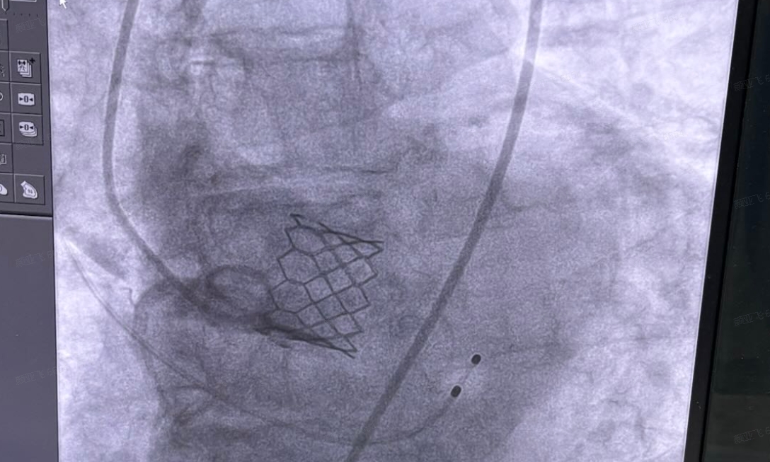 SunValve TAVI angiography, post-procedural result